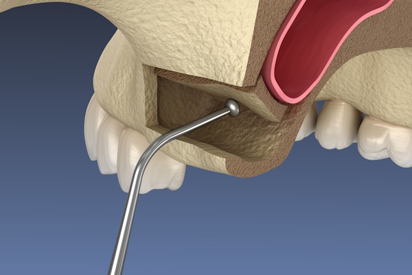 Sinus Lift Surgery - Moving sinus membrane. 3D illustration